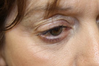 Vampire Facelift 3 - After Treatment